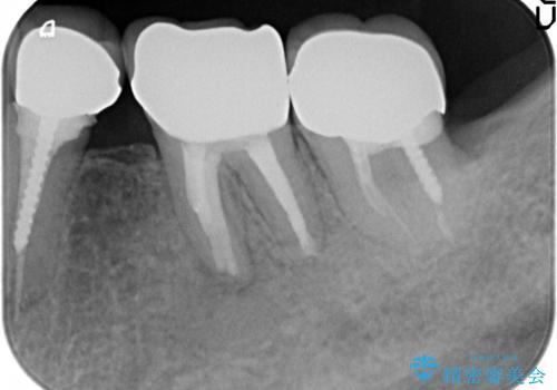 オールセラミッククラウン 痛くて咬めない奥歯の治療の治療後