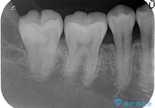 セラミックインレー 冷たいものがしみる奥歯の治療の治療前