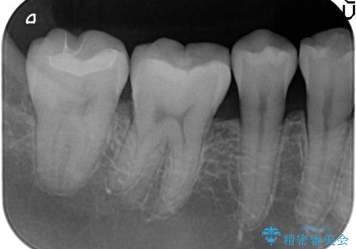 セラミックインレー 冷たいものがしみる奥歯の治療の治療後