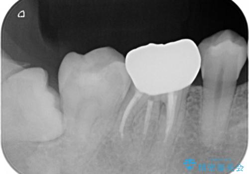 被せ物の下で進行してしまった虫歯の治療の治療後