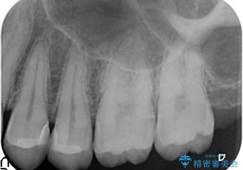 X線撮影によりわかる、内在する虫歯治療の治療後