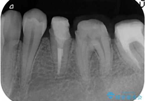 歯ぐきからの出血 歯周外科による改善の治療中