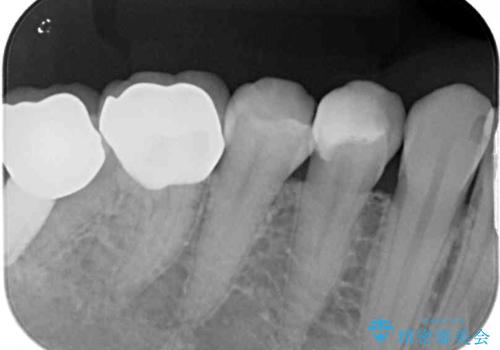 奥歯がしみる セラミックインレーによるむし歯治療の治療前