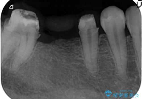 インプラントを用いた臼歯部欠損補綴の治療中