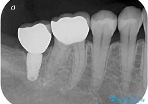 奥歯がしみる　セラミックインレーによるむし歯治療の治療後