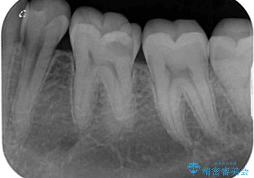 神経近くにまで及んだ大きなむし歯のセラミッククラウンの治療前