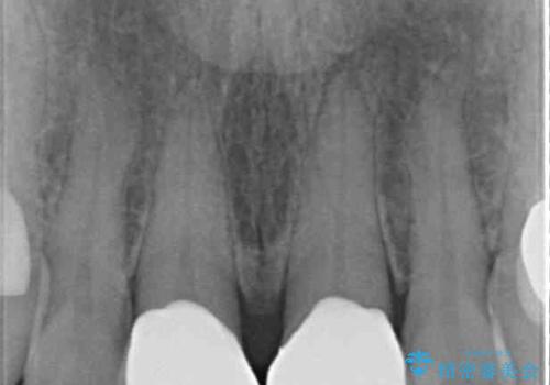 度重なる治療で前歯がしみる オールセラミッククラウンによる補綴治療の治療後
