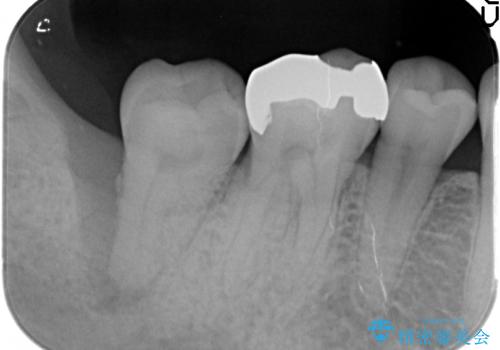 抜歯時歯槽堤保存術を用いた骨造成・インプラント治療の治療前