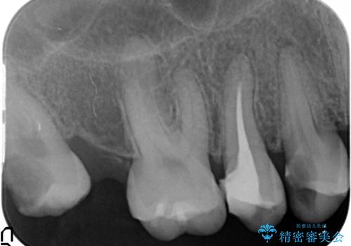 インプラントを用いた臼歯部欠損補綴の治療前