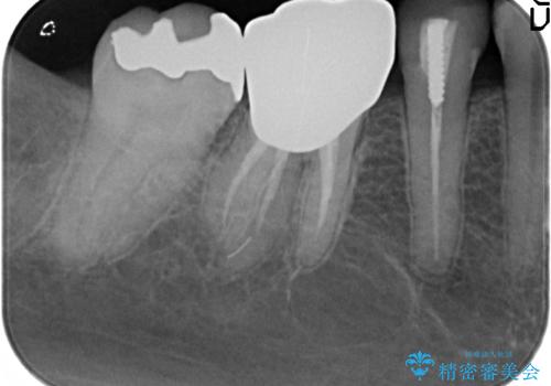 PGA(ゴールド)インレー　しみる銀歯の虫歯治療の治療前