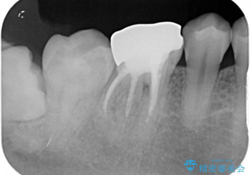 被せ物の下で進行してしまった虫歯の治療の治療前