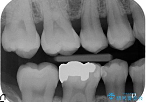 オールセラミッククラウン　目立つ銀歯を白い歯への治療前