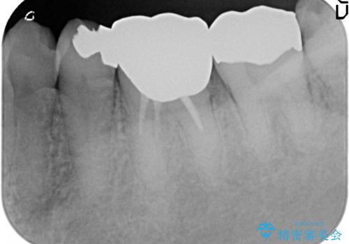 オールセラミッククラウン 他院にて抜歯と言われた歯の治療の治療前