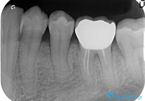50代男性 受け口 他院で5年以上かかると治療を断られたの治療後