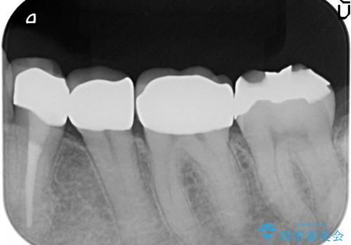 オールセラミッククラウン 奥歯の銀歯を白くの治療後