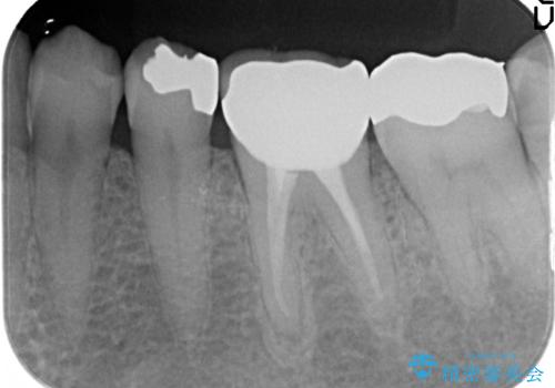 オールセラミッククラウン 他院にて抜歯と言われた歯の治療の治療後
