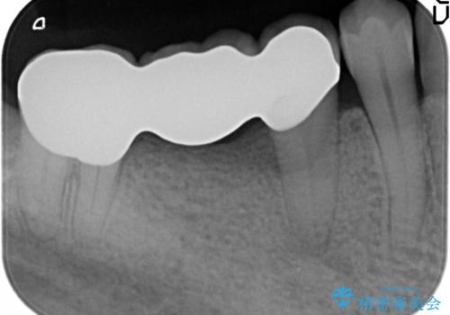 50代男性 受け口 他院で5年以上かかると治療を断られたの治療後