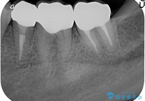 歯ぐきからの出血 歯周外科による改善の治療後