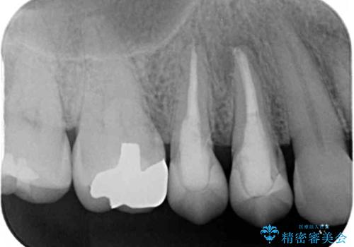 治療途中で放置していた歯 オールセラミッククラウンによる補綴治療の治療後