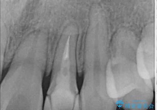 話しにくい歯並びの改善 抜歯矯正治療と前歯の審美治療の治療前