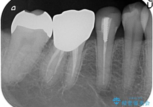 PGA(ゴールド)インレー　しみる銀歯の虫歯治療の治療後