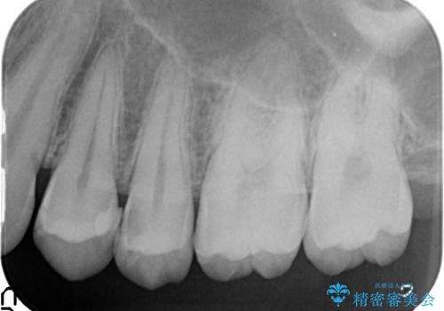 X線撮影によりわかる、内在する虫歯治療の治療前