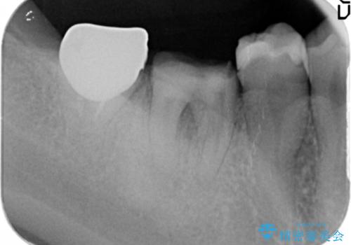セラミックブリッジによる審美・咬合機能回復治療の治療前