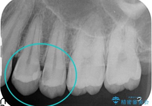 X線撮影によりわかる、内在する虫歯治療