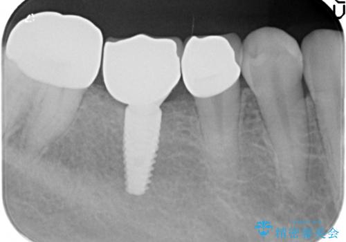 インプラントを用いた臼歯部欠損補綴の治療後