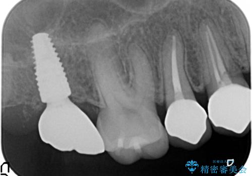 インプラントを用いた臼歯部欠損補綴の治療後