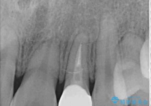 話しにくい歯並びの改善 抜歯矯正治療と前歯の審美治療の治療後