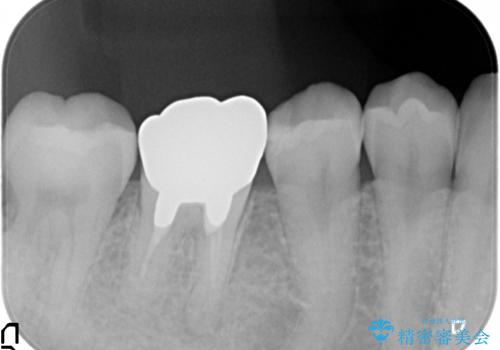 オールセラミッククラウン 鈍い痛みが続く奥歯の治療の治療前