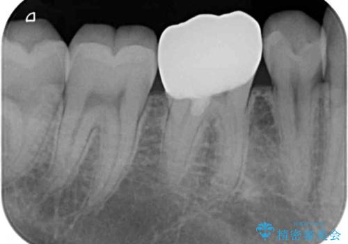 神経近くにまで及んだ大きなむし歯のセラミッククラウンの治療後