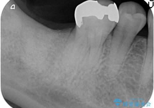 抜歯時歯槽堤保存術を用いた骨造成・インプラント治療の治療中