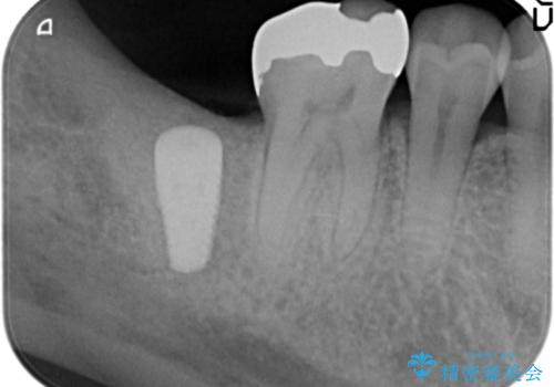 抜歯時歯槽堤保存術を用いた骨造成・インプラント治療の治療中