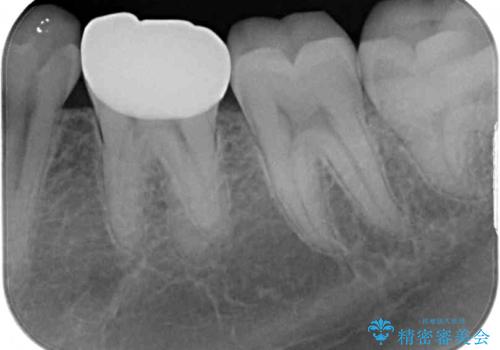 神経近くにまで及んだ大きなむし歯のセラミッククラウンの治療後
