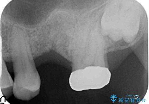 奥歯のインプラント　ソケットリフト　60代男性の治療前