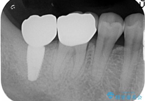 抜歯時歯槽堤保存術を用いた骨造成・インプラント治療の治療後