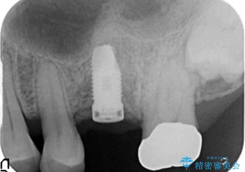 奥歯のインプラント　ソケットリフト　60代男性の治療中