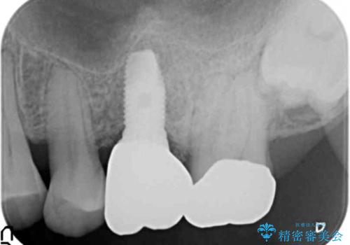 奥歯のインプラント　ソケットリフト　60代男性の治療後