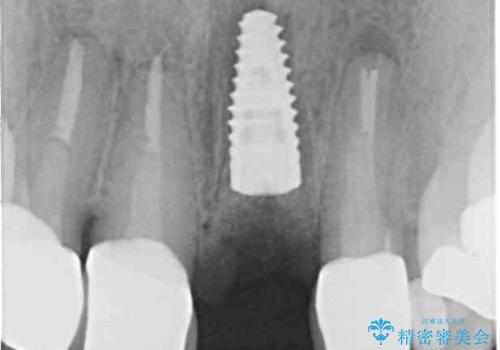 折れてしまった前歯 インプラントによる補綴治療の治療中