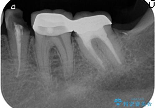 歯ぐきからの出血 歯周外科による改善の治療前