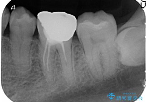 50代男性 受け口 他院で5年以上かかると治療を断られたの治療前