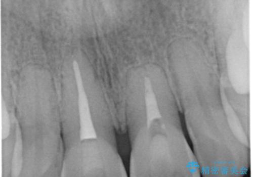 歯を白くしたい‐ウォーキングブリーチで内側から白くの治療中
