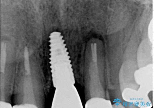 折れてしまった前歯 インプラントによる補綴治療の治療後