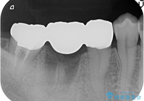 セラミックブリッジによる審美・咬合機能回復治療の治療後