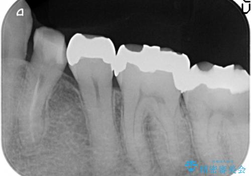 オールセラミッククラウン 奥歯の銀歯を白くの治療前
