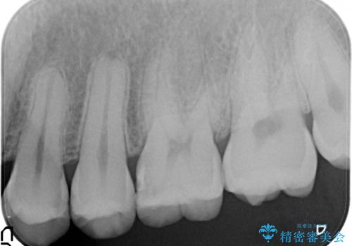 虫歯を治したい、セラミックによる治療の治療前