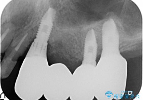 [入れ歯にしたくない] 臼歯部インプラント補綴の治療後