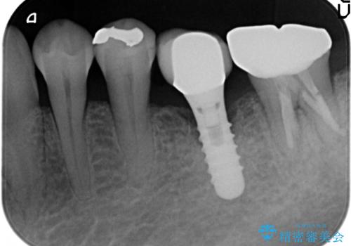 セラミックインレー 気になる銀歯を白くの治療前